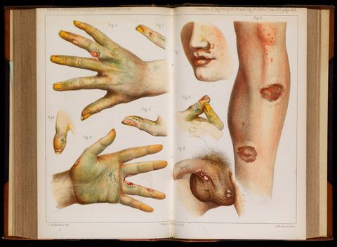 Acidentes causados pelo uso de pigmentos verdes com Arsênio. Créditos: Accidents caused by the use of green arsenic, 1859. Credit: Wellcome Collection. Attribution 4.0 International (CC BY 4.0).